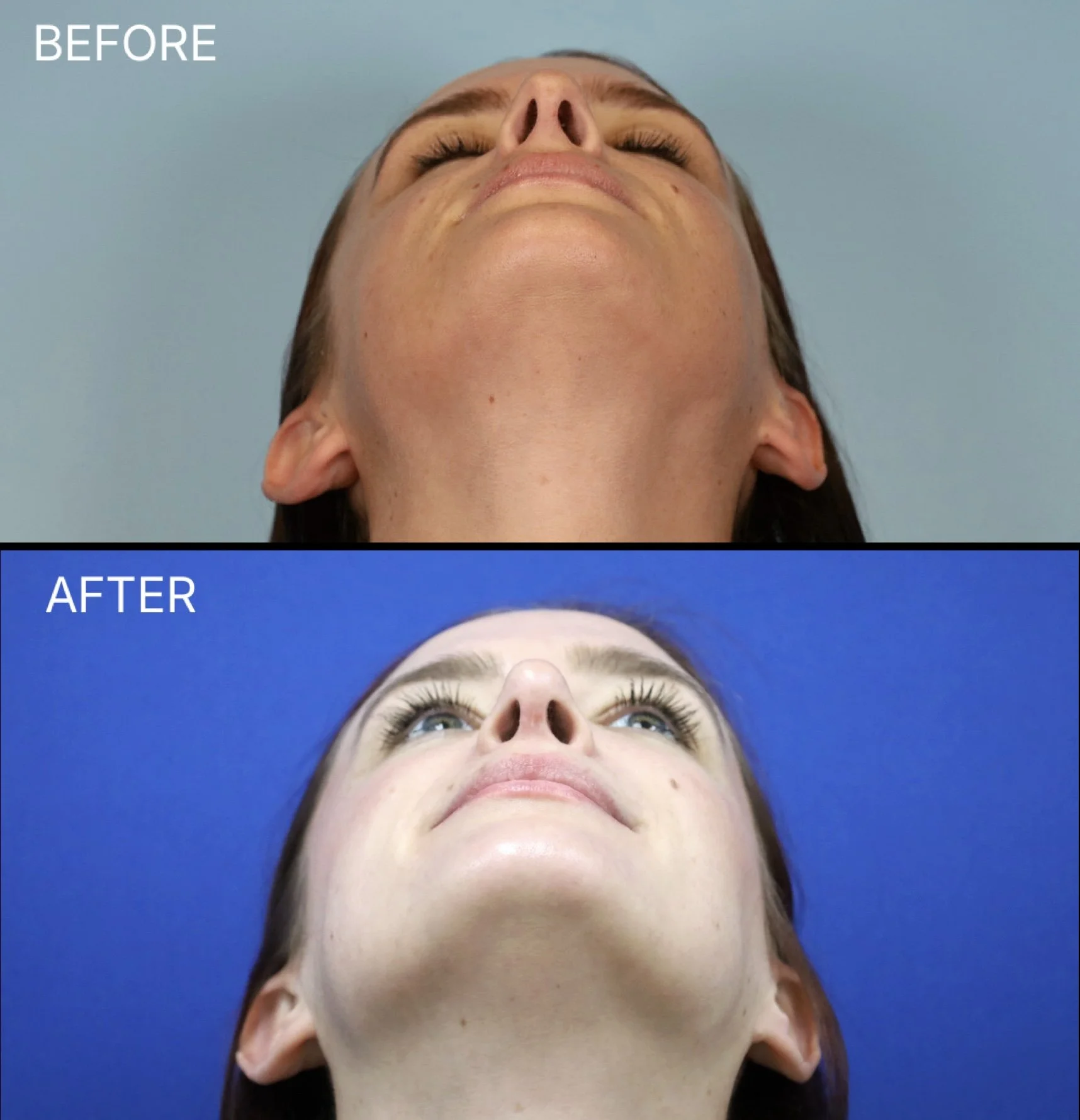 This female patient wanted to address the dorsal hump, decrease the nasal projection, and refine the nasal tip. After 10 months, the soft tissue swelling continues to decrease, and her nose is healing beautifully