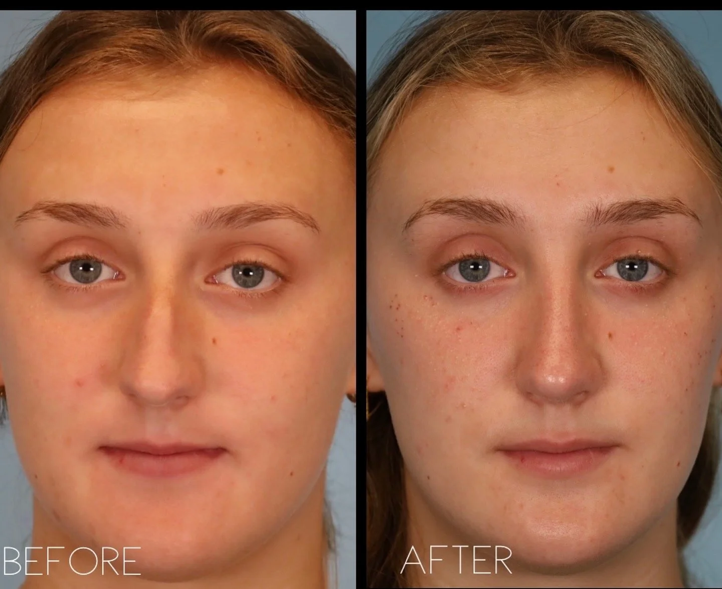 This 18 year old  patient wanted to address the dorsal hump and refine the nasal tip, in addition to improving her nasal breathing.