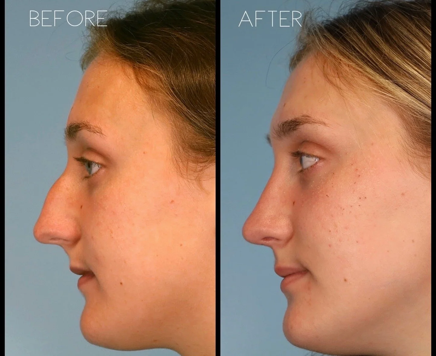 This 18 year old  patient wanted to address the dorsal hump and refine the nasal tip, in addition to improving her nasal breathing.