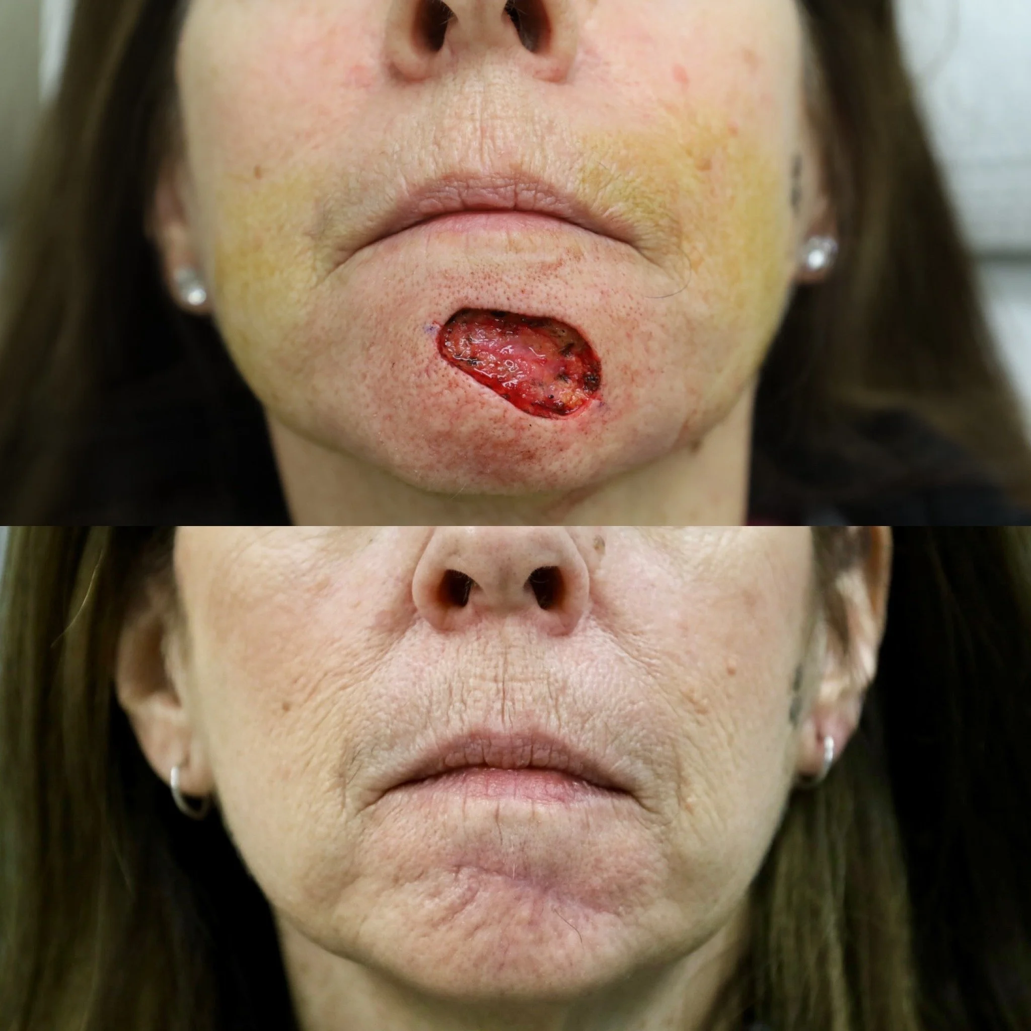 This patient consulted with Dr. Kumar for the reconstruction of a large chin defect after her dermatologist removed the skin cancer. This is her before and now 4 months after reconstruction. Full wound healing can take up to 1 year, and she is alread