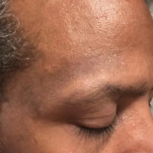 after 6 treatments; fully healed