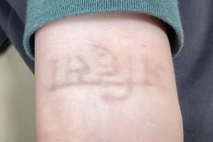 after 5 treatments
