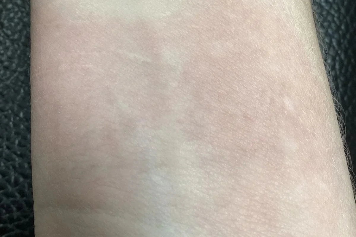 after 6 treatments; 1 year fully healed