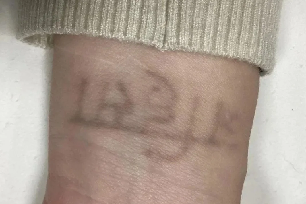 after 4 treatments