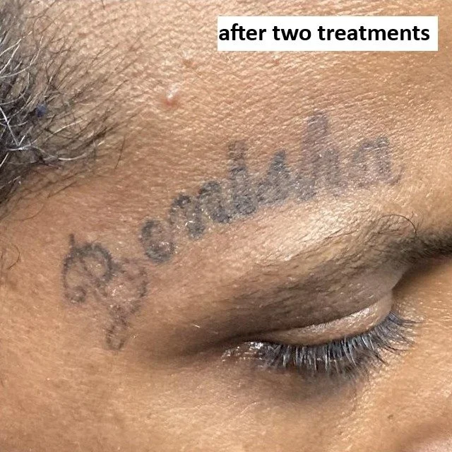 after 2 treatments