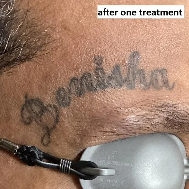 after 1 treatment