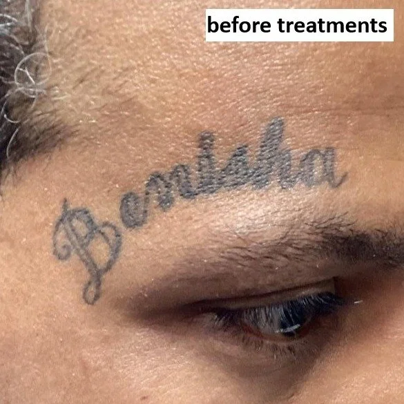 before treatments