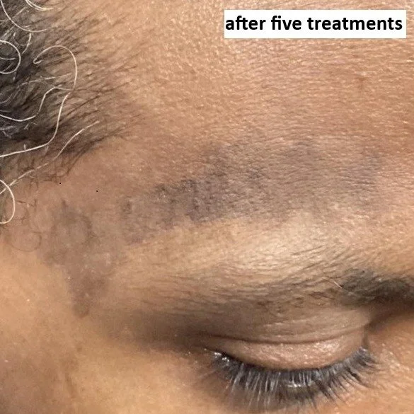 after 5 treatments
