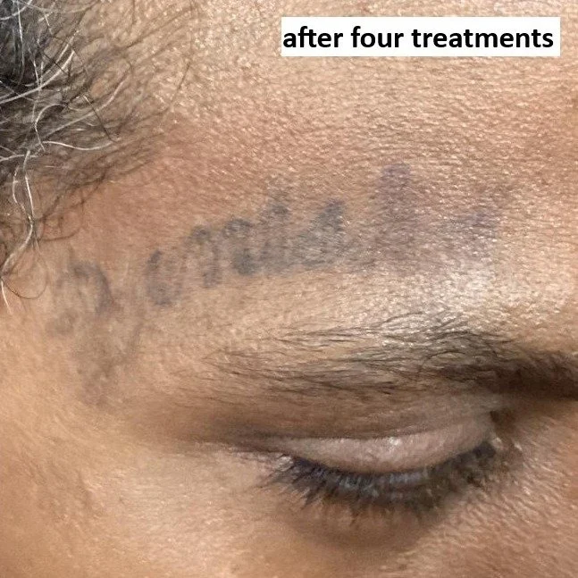 after 4 treatments