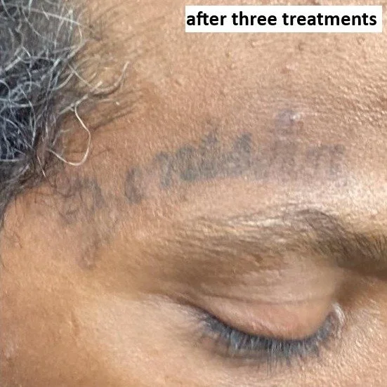 after 3 treatments