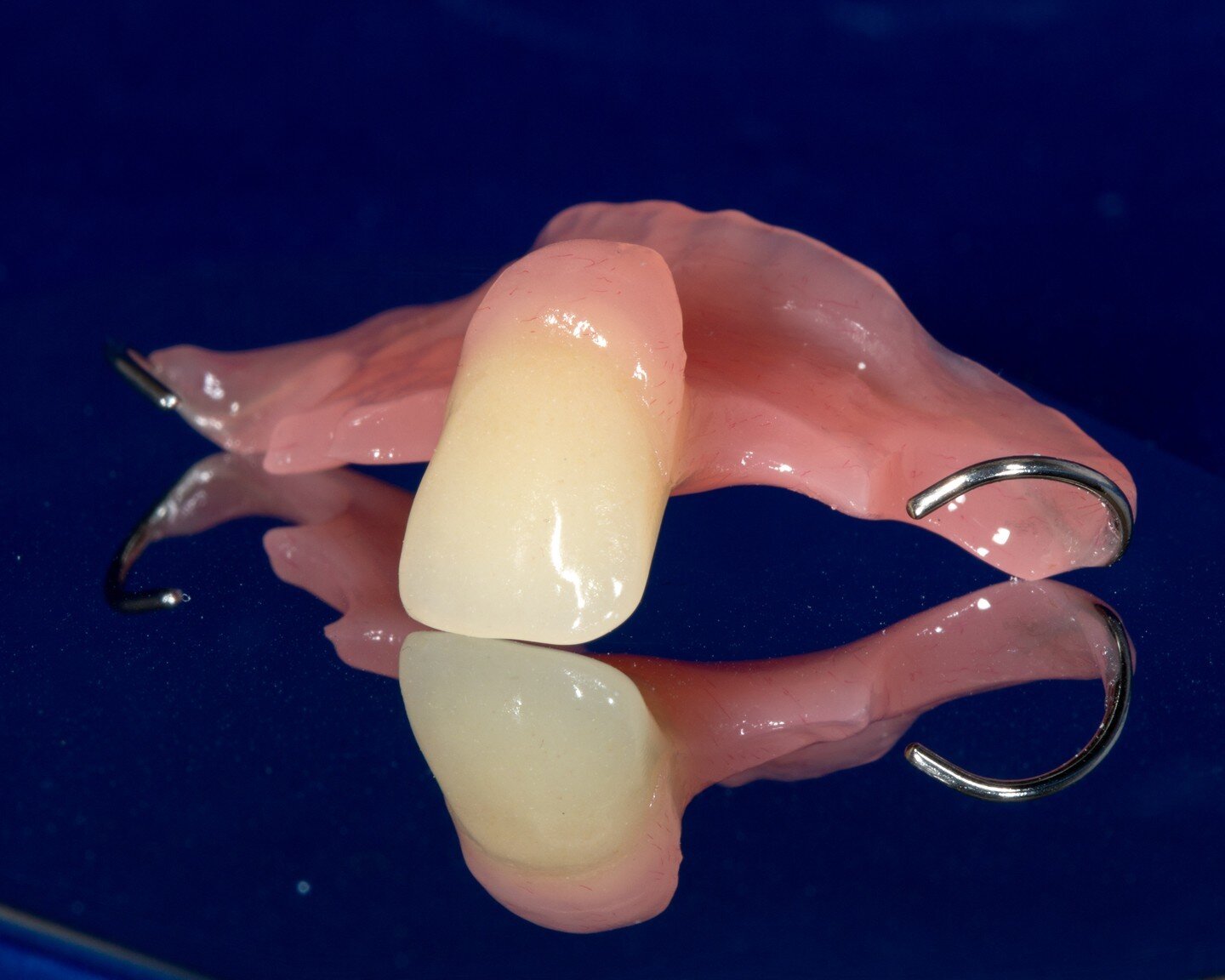 The single-tooth anterior denture can be one of the most important prosthesis a lab can make. 

It's an economical and quick way to restore a smile.  Sometimes serving as a long-term solution and sometimes a quick fix  provisional option during impla