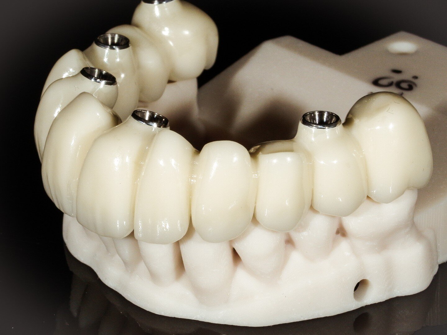 This type of case is life-changing.  The surgeon chose to use five Straumann implants with SRAs.  These SRAs draw from multiple angles allowing multiple units to seat without binding.