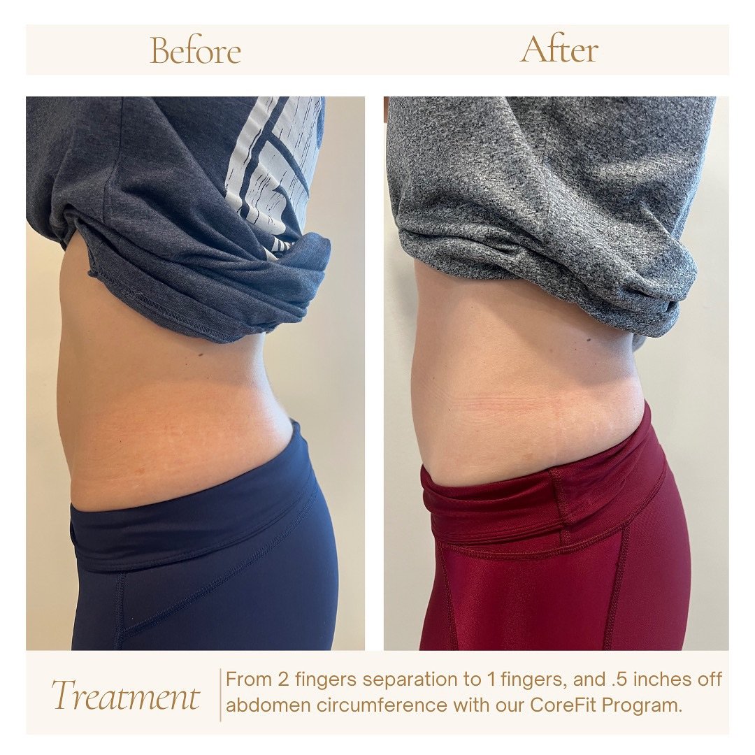 🌟 Witness incredible results from the CoreFit Program at Bump and Beyond! 🌟 Participants are celebrating significant progress, including achieving a full finger of closure in diastasis recti and shedding 0.5 inches off their waist circumference fro