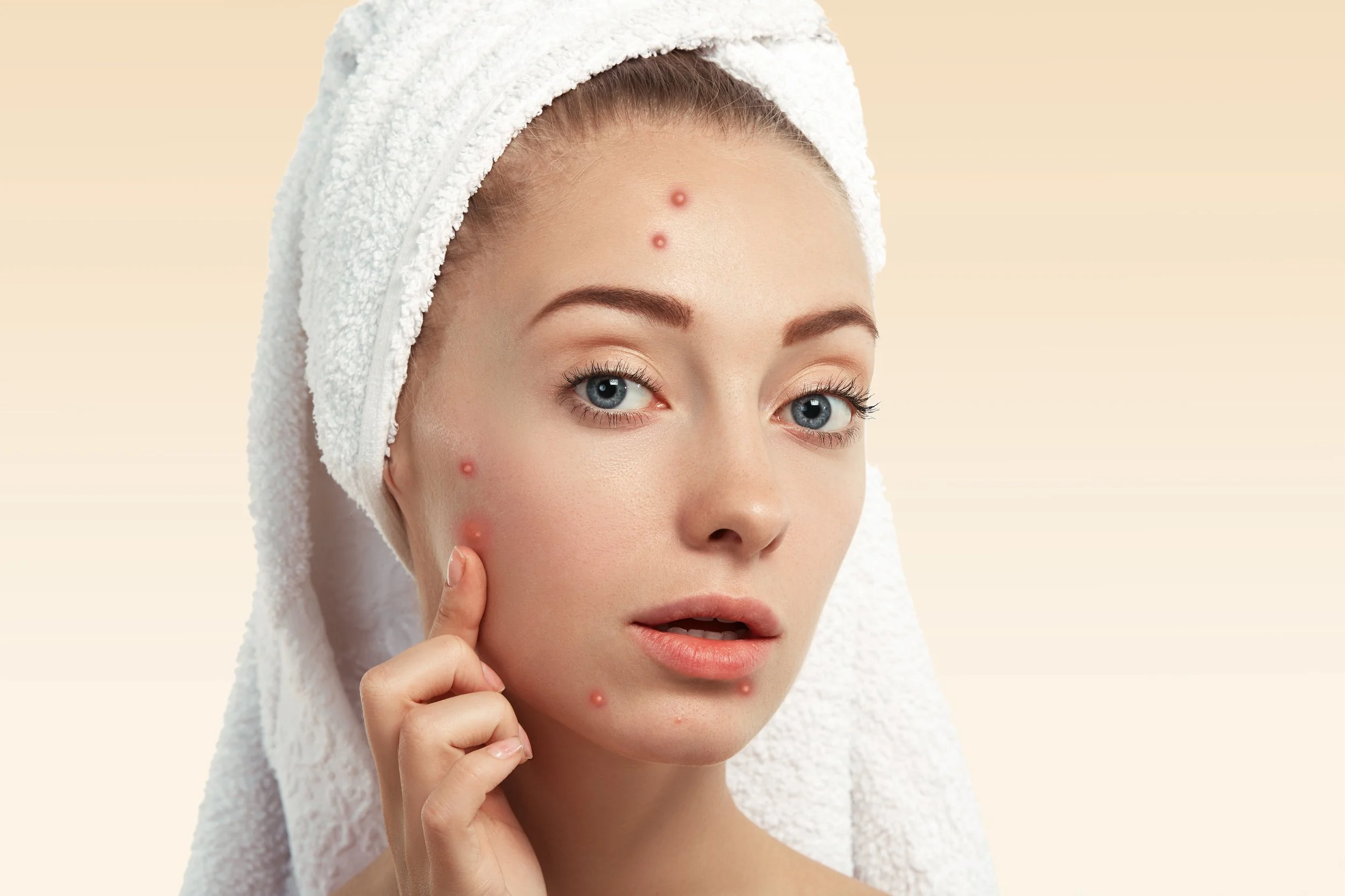 woman in hair towel pointing to acne skin