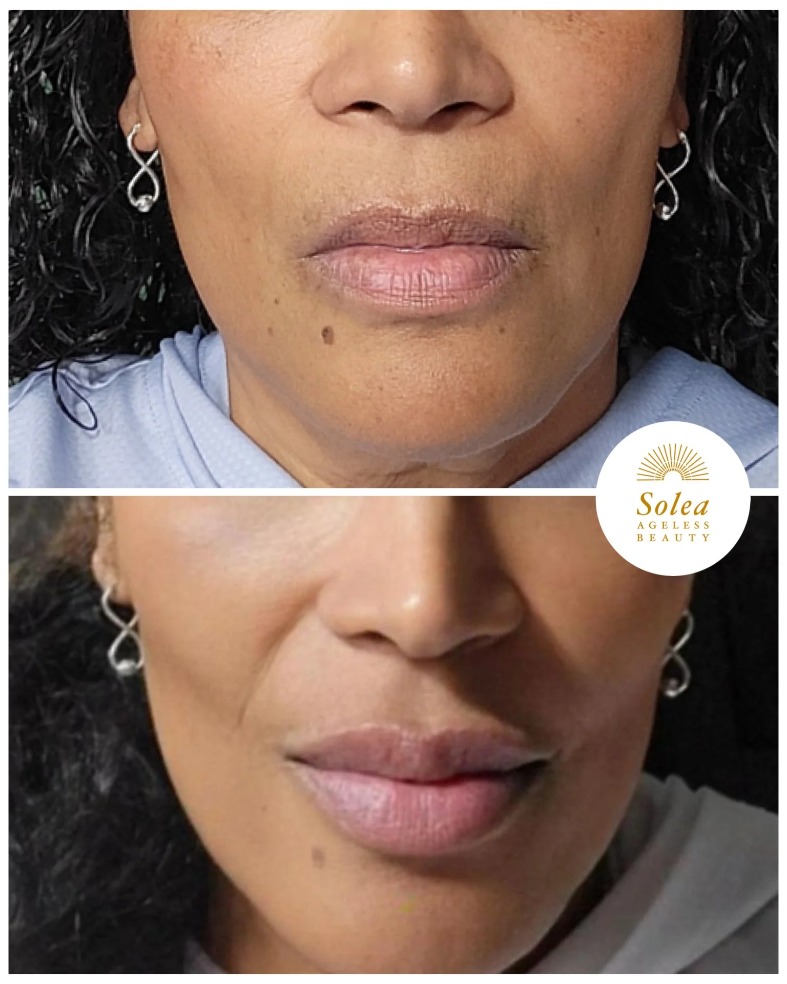 Before and after close-up photos of a woman showing improved skin and lip appearance