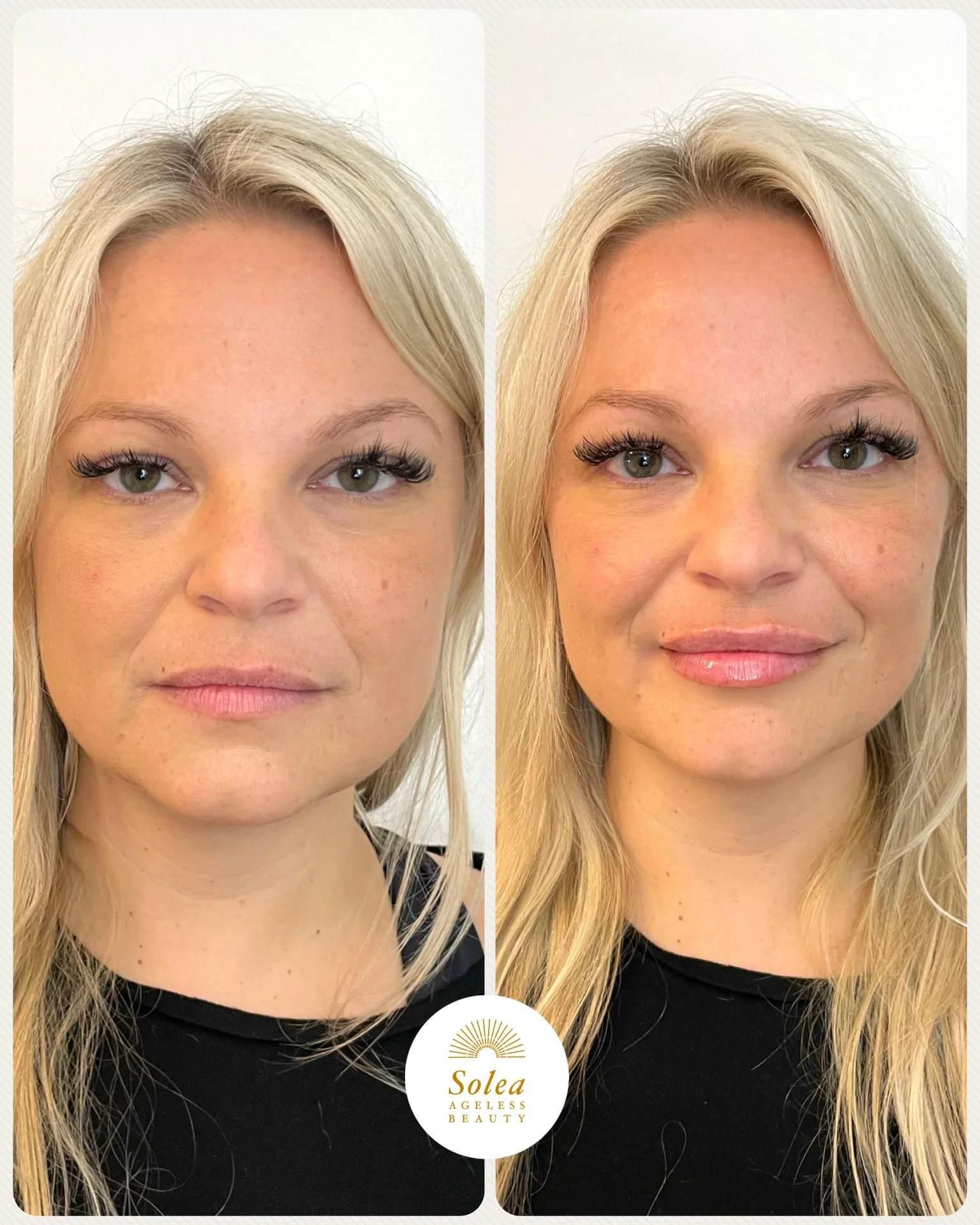 Side-by-side comparison of a woman's face before and after cosmetic enhancement, displaying smoother skin and enhanced features, with the Soleil Ageless Beauty logo at the bottom.