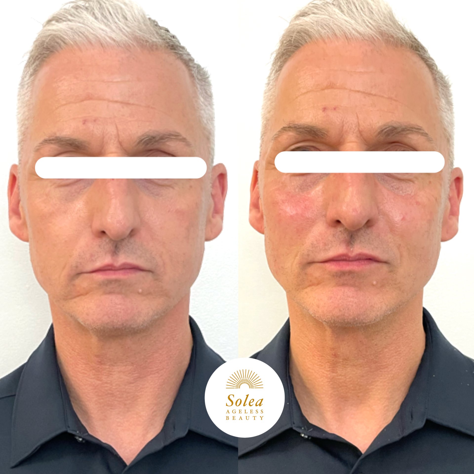 Side-by-side comparison of a middle-aged man before and after facial treatment, with visible skin improvements such as reduced wrinkles and redness. The man has short gray hair and is wearing a black collared shirt.