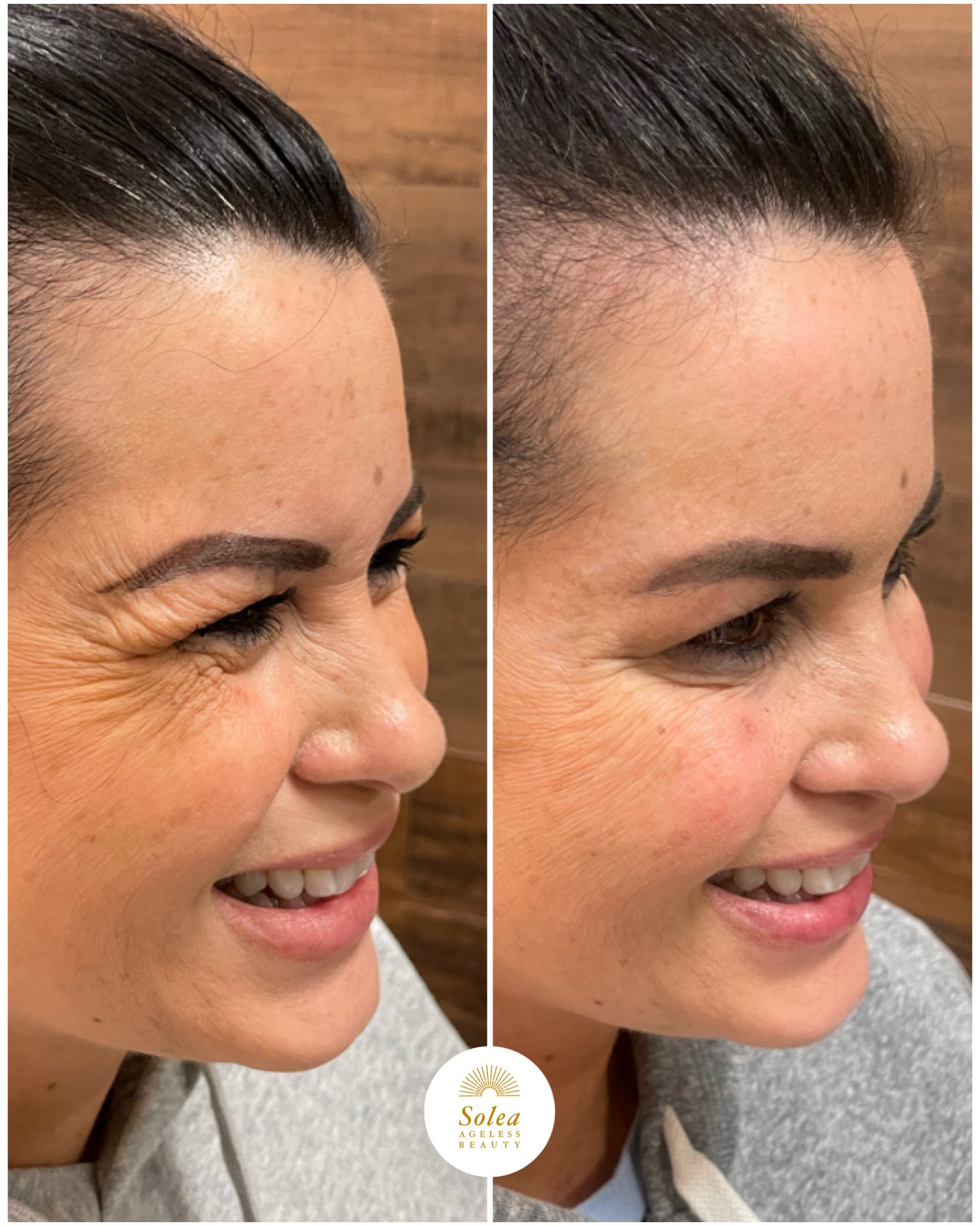 Comparison of a woman's face showing reduced wrinkles around the eye in a before and after skincare treatment. The before side shows more prominent wrinkles, while the after side shows smoother skin.