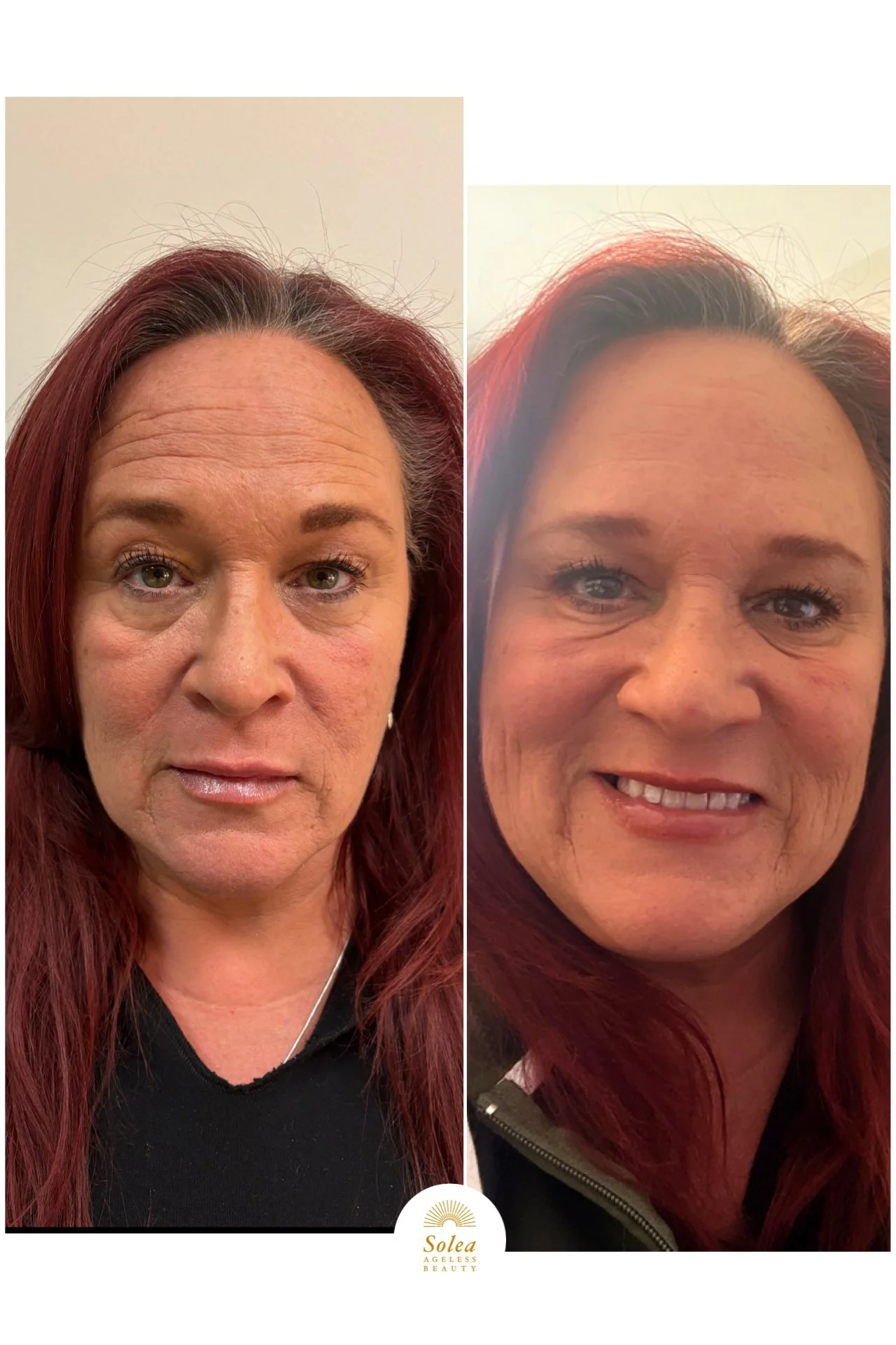 Side-by-side comparison of a woman's face before and after aesthetic treatment, showing improved skin texture and appearance, with the logo 'Solea Ageless Beauty' at the bottom.