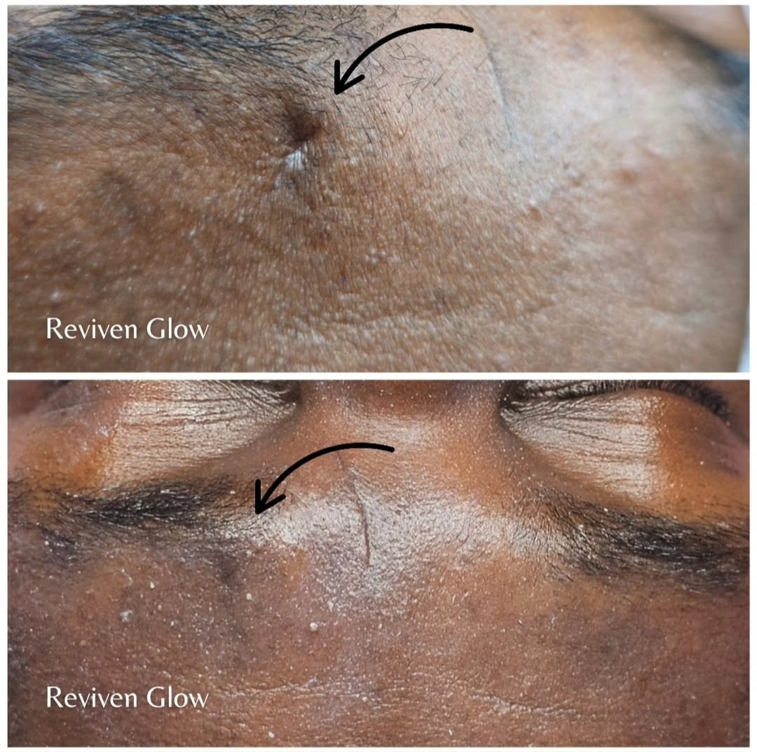 Close-up photo showing skin with a small blemish in the upper part marked with an arrow, and a shiny, slightly irritated area with some white residue below, both labeled "Reviven Glow."