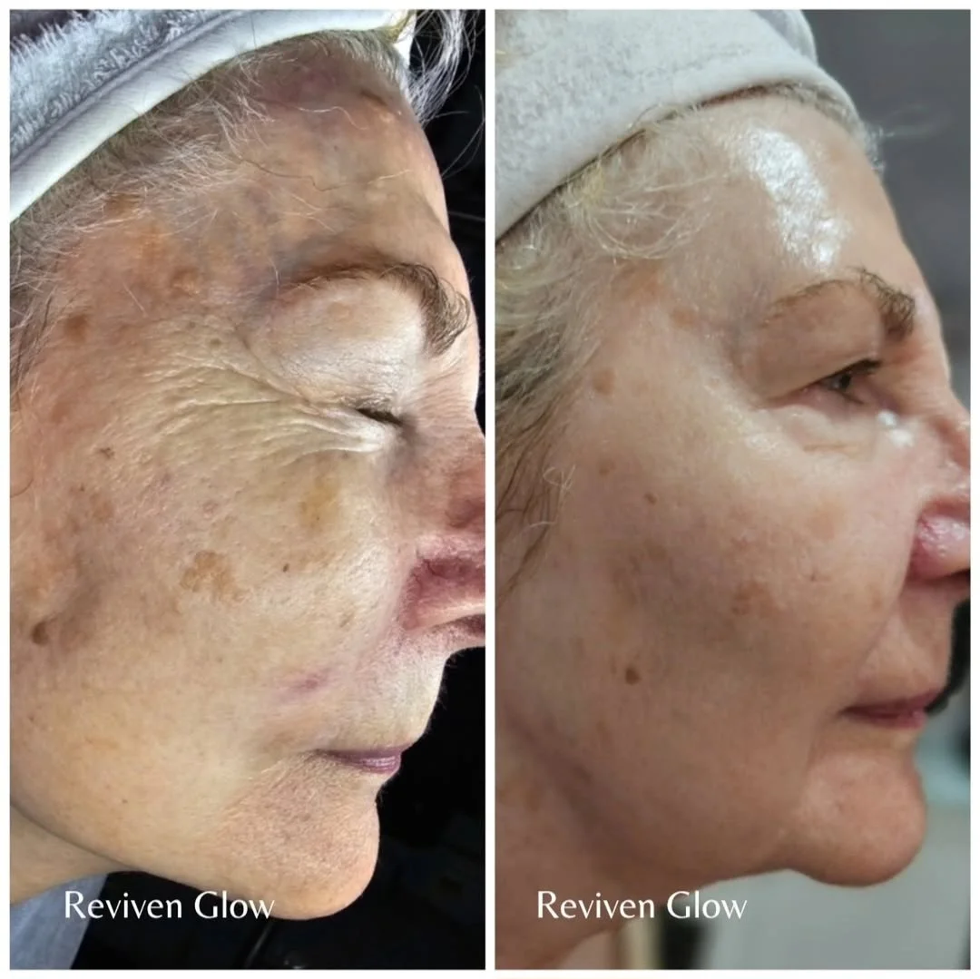 Side-by-side comparison of a woman's face before and after skincare treatment, showing improved skin texture and reduced age spots, labeled 'Reviven Glow'.