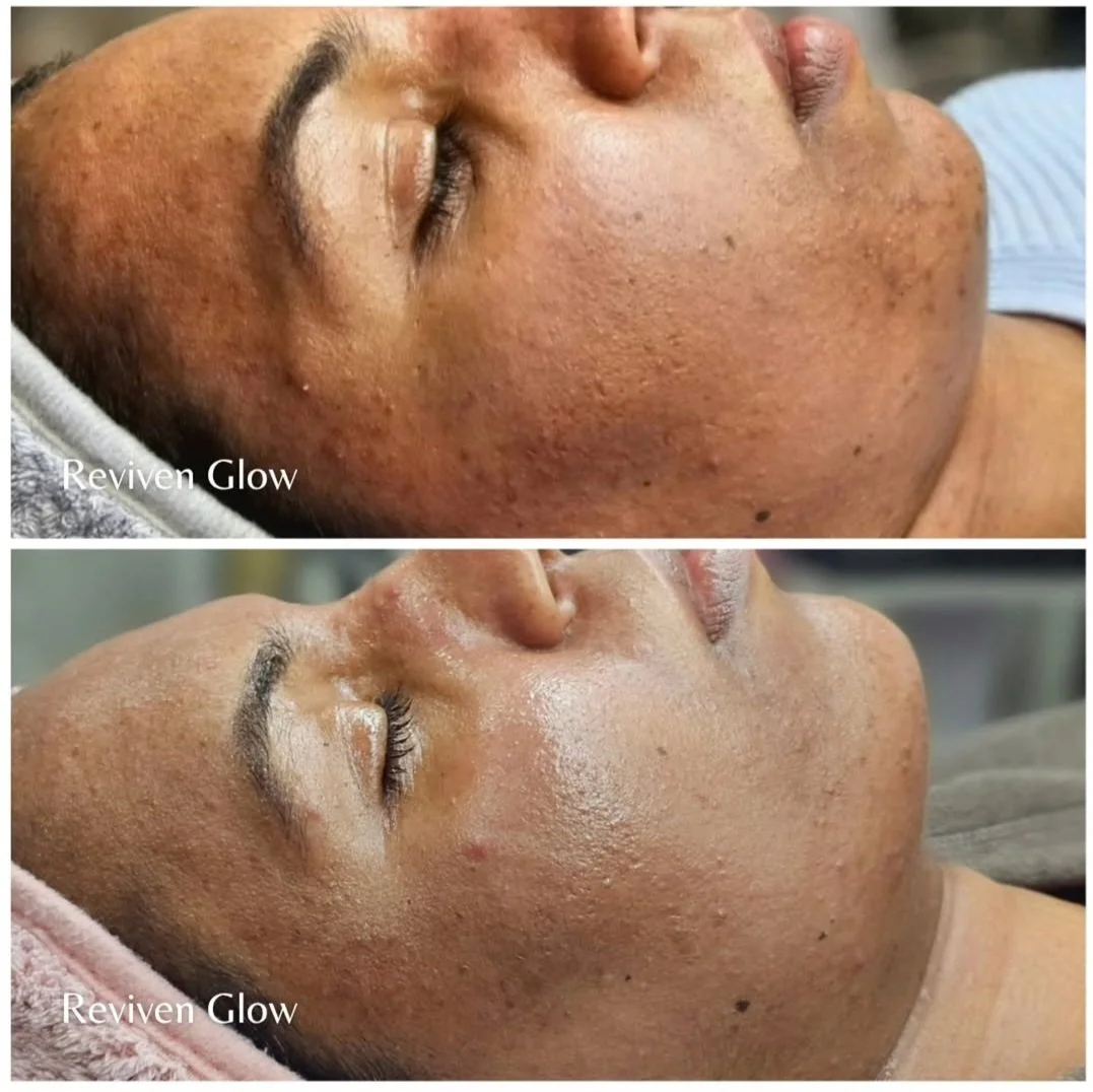Side-by-side comparison of a woman's face before and after a skincare treatment showing improved skin texture and clarity.