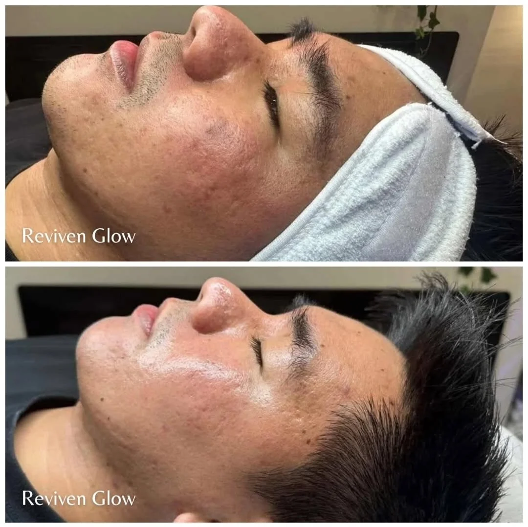 Side-by-side comparison of a man's face before and after a skincare treatment showing improved skin clarity and texture. The man is lying down with a towel wrapped around his head.