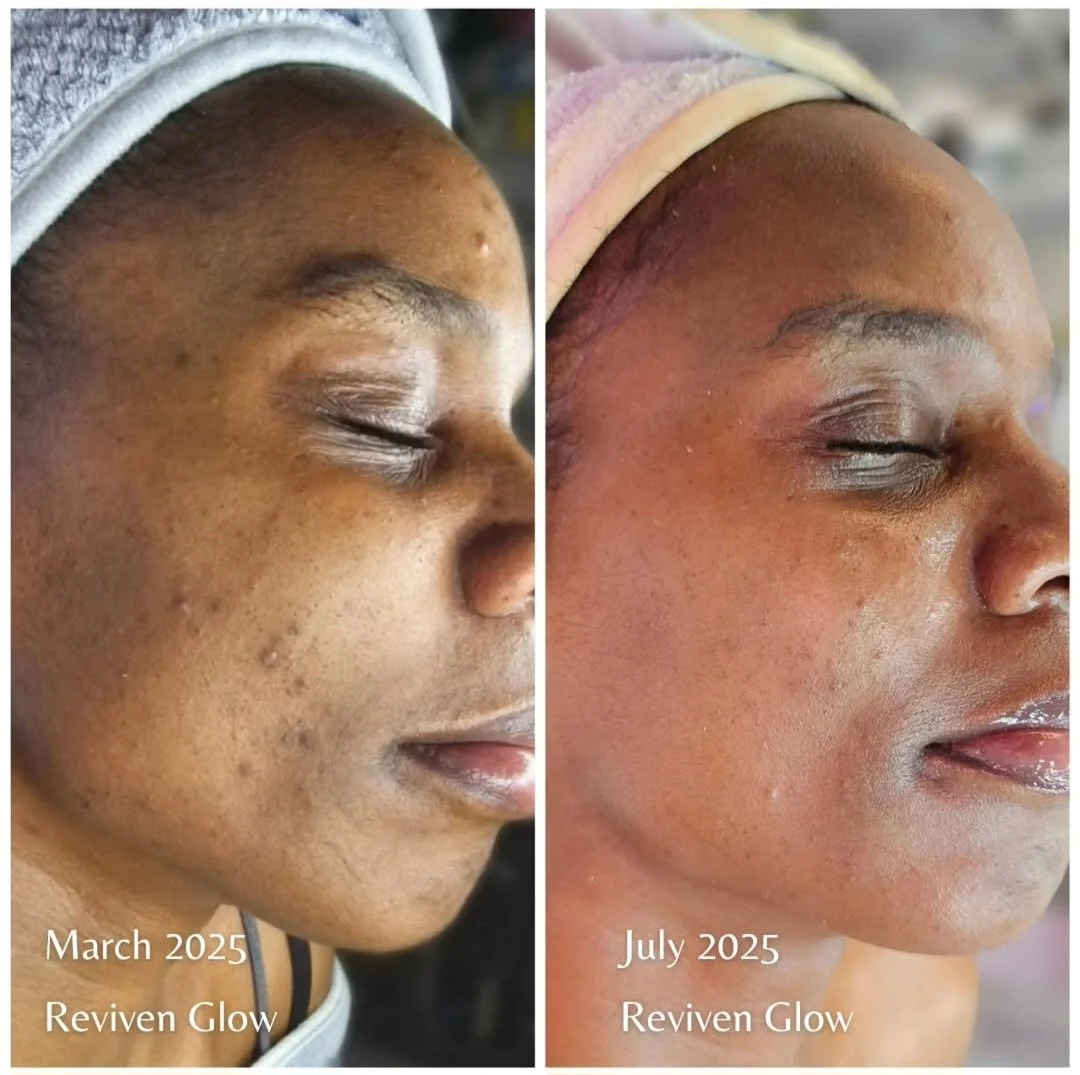 Side-by-side comparison of a woman's face showing skin improvement from March 2025 to July 2025 after using Reviven Glow, with visible reduction in acne and skin texture changes.
