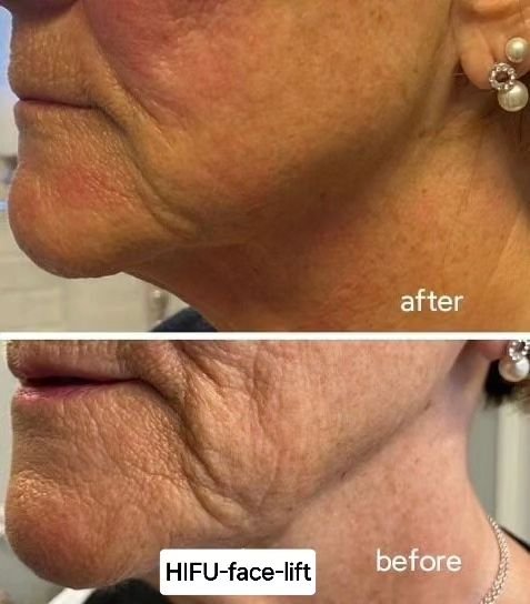 Get tighter skin without surgery with HIFU! 😍 
Generally, however, results can take up to three months (12 weeks) to show. The results continue to get better over time for up to six months as the collagen production gets to work.&nbsp;
#noninvasive 