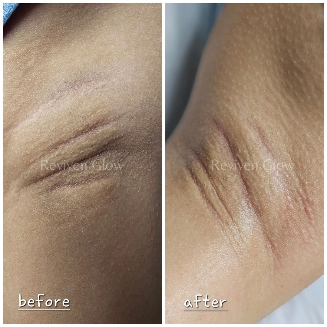 Immediate results after a single session of the Pink Intimate Brightening treatment. 100% safe for all skin tones. We recommend four to six sessions for better and more visible results.
 #selfcare #beauty #skincare #intimatecare