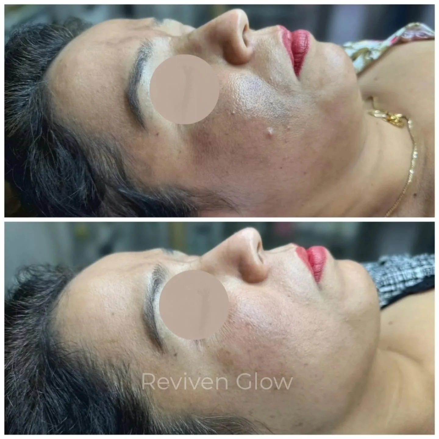 Melasma with skin damage caused by a chemical peel without proper skin preparation, burned from a previous chemical peel done elsewhere.

Skin damage from an incorrect chemical peel can be scary, but it&rsquo;s not the end of the journey. 
With the r