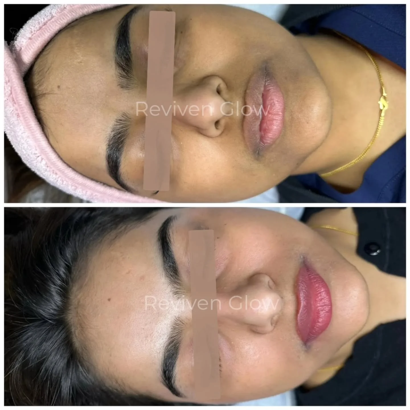 Transform uneven skin tone with a customized treatment plan designed to target melasma, sun damage, post-inflammatory pigmentation, and stubborn dark spots. 

This program combines advanced in-clinic treatments with medical-grade skincare to safely b
