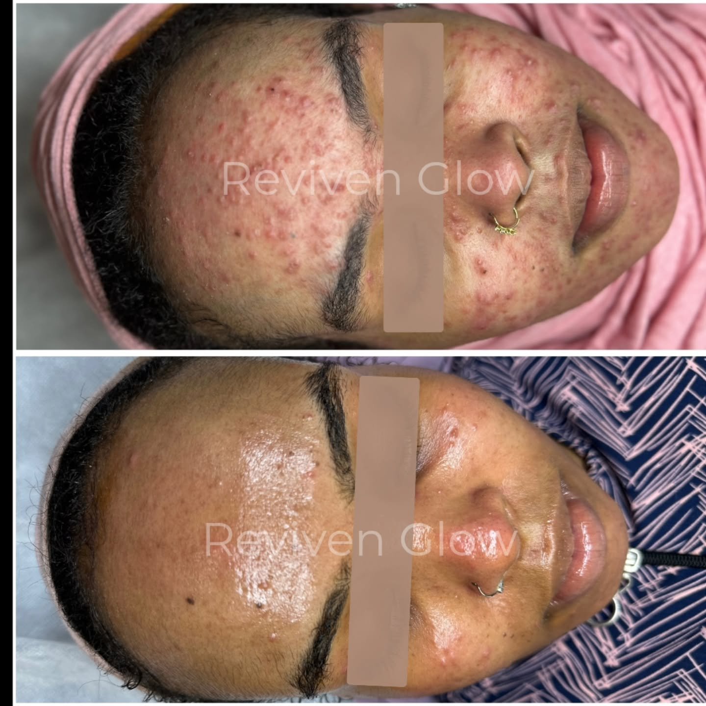Patience > Perfection. ✨ Swipe to see the journey &rarr;

She came to me feeling hopeless about her acne...
Now she can't stop glowing.

She almost gave up on her skin.

Tried everything. Covered it with facemask. Avoided mirrors.

But she didn't 