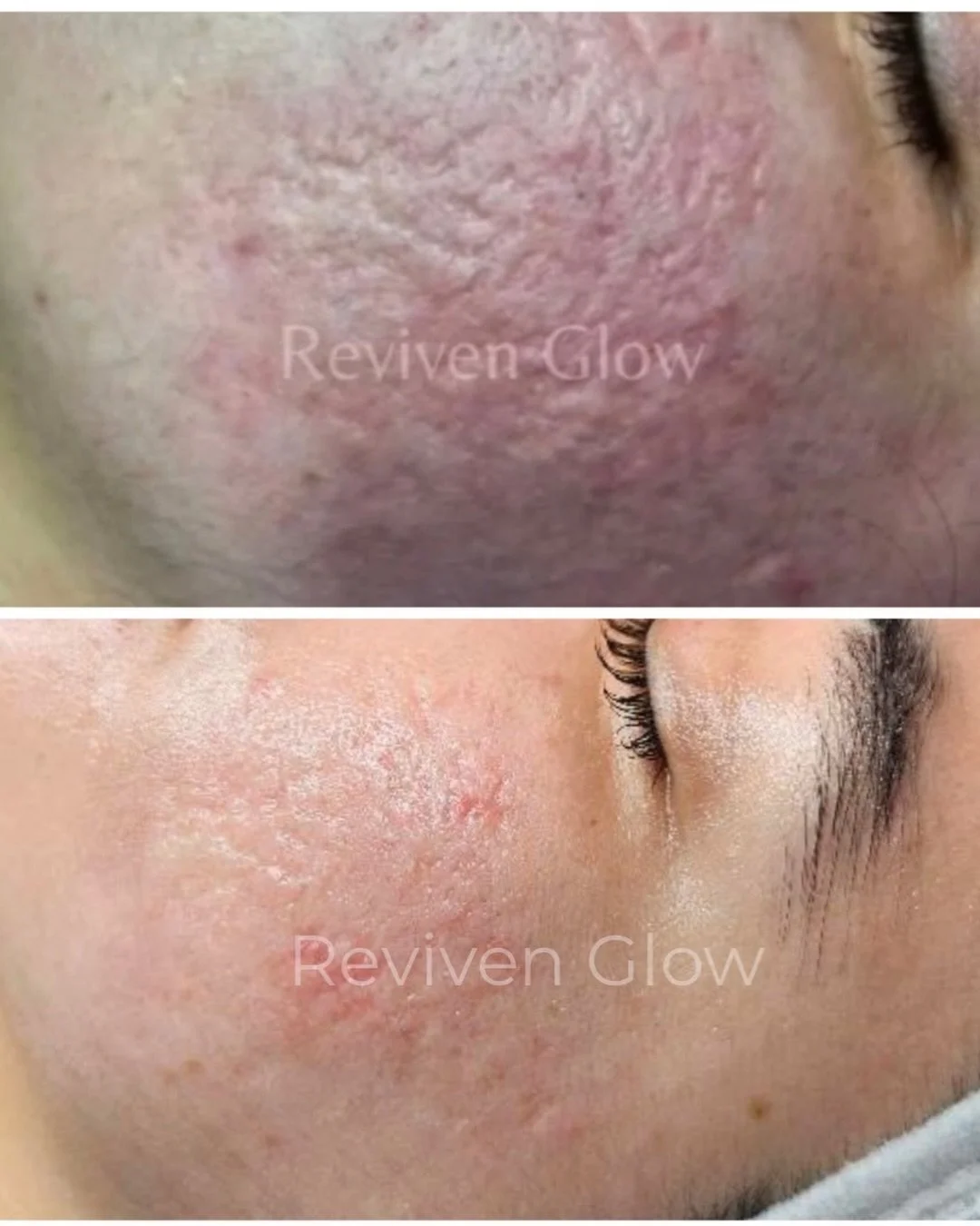Acne Scar Transformation - Still In Progress ✨

This client came with long-term acne scars, uneven texture, and post-inflammatory marks that did not improve with previous treatments.

We created a customized Scar Revision plan focused on precision tr