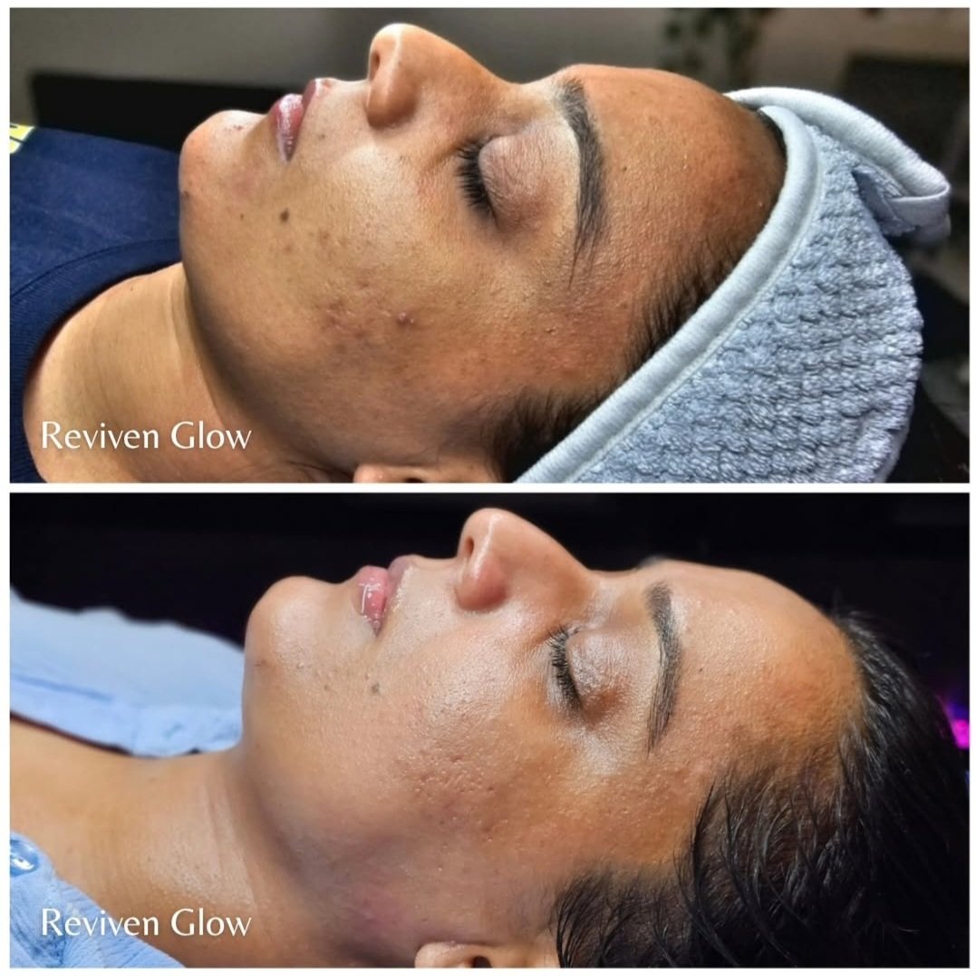 Side-by-side comparison of a woman's face before and after a skincare treatment, showing improvements in skin smoothness and texture on the 'after' side, both images taken with her eyes closed and a head covering.