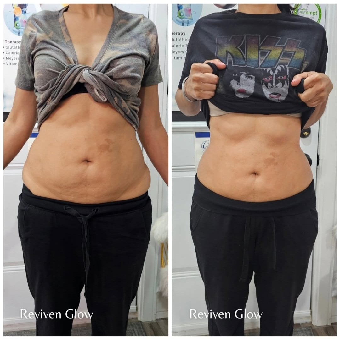 Side-by-side comparison of a woman's midsection before and after using Reviven Glow, showing visible skin improvements and reduced appearance of stretch marks.