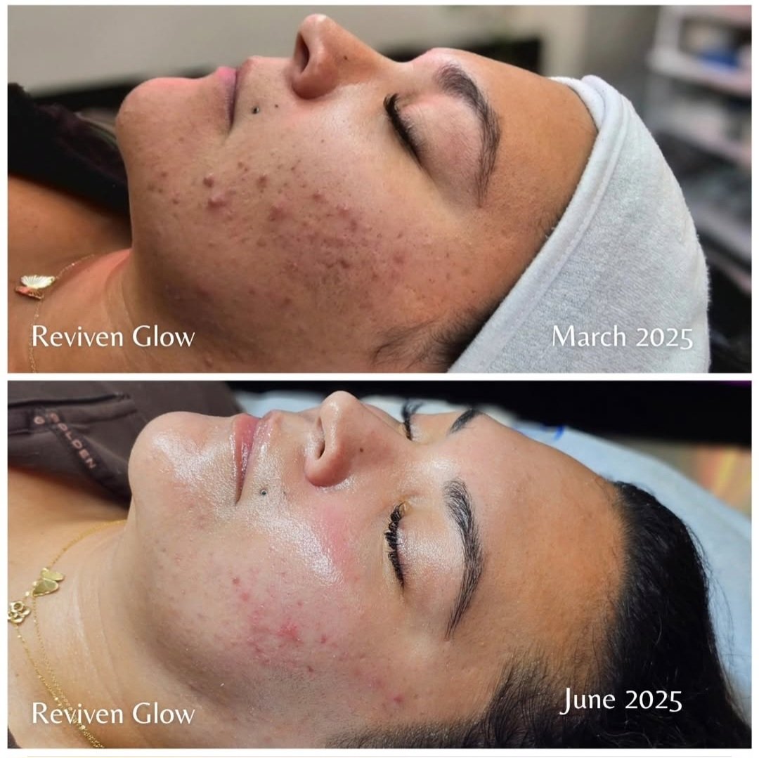 A side-by-side comparison of a woman's face before and after skincare treatments at Reviven Glow. The top image, labeled March 2025, shows her with acne scars and blemishes, while the bottom image, labeled June 2025, shows her with clearer, smoother skin.