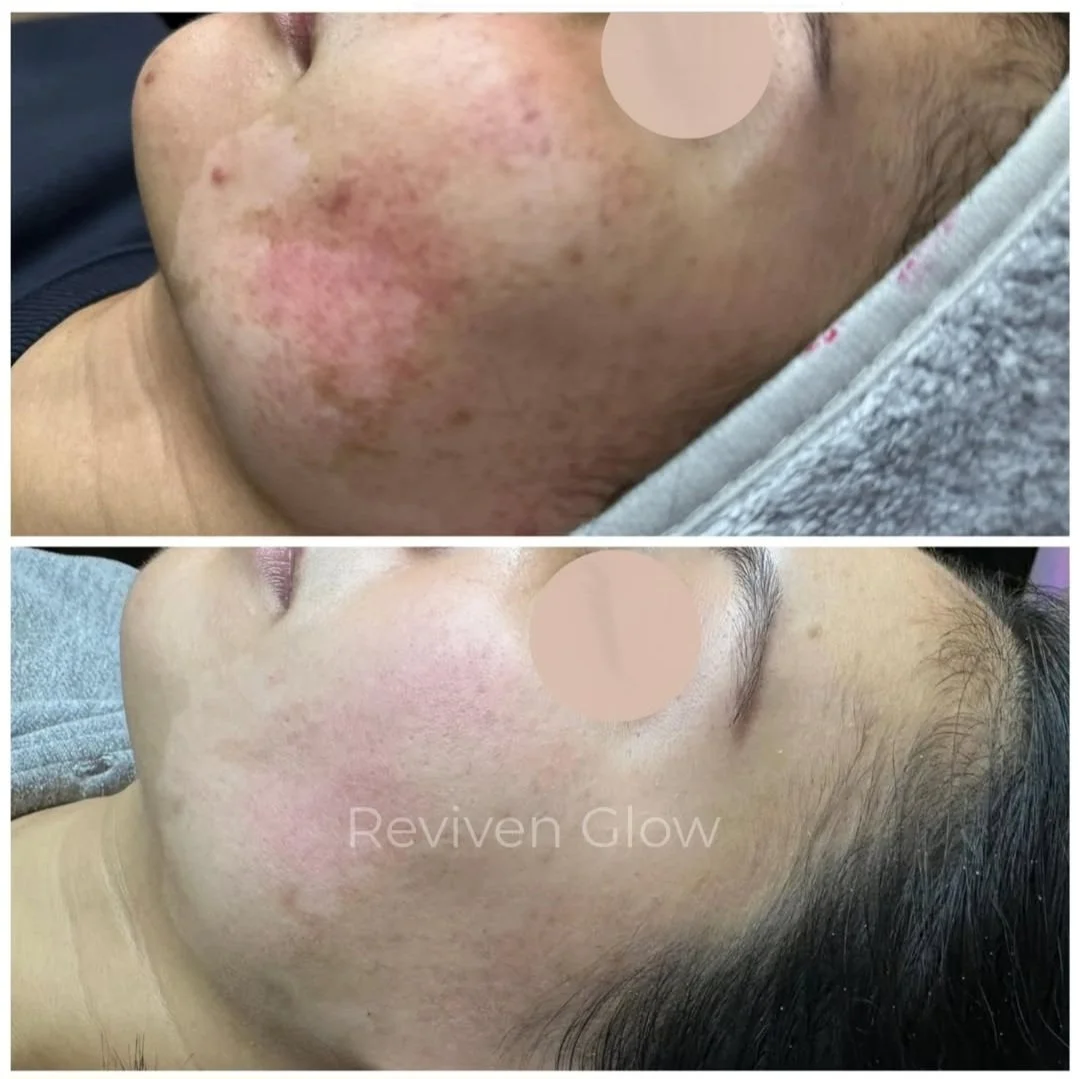 Side-by-side comparison of facial skin before and after skincare treatment, showing significant improvement in skin condition with reduced acne and redness.