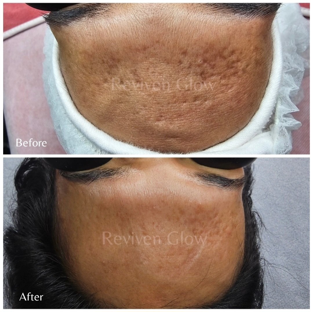 Before and after images of a person's forehead showing improved skin texture and clarity after treatment, with the before image indicating uneven, scarred skin and the after image showing smoother skin with fewer scars.