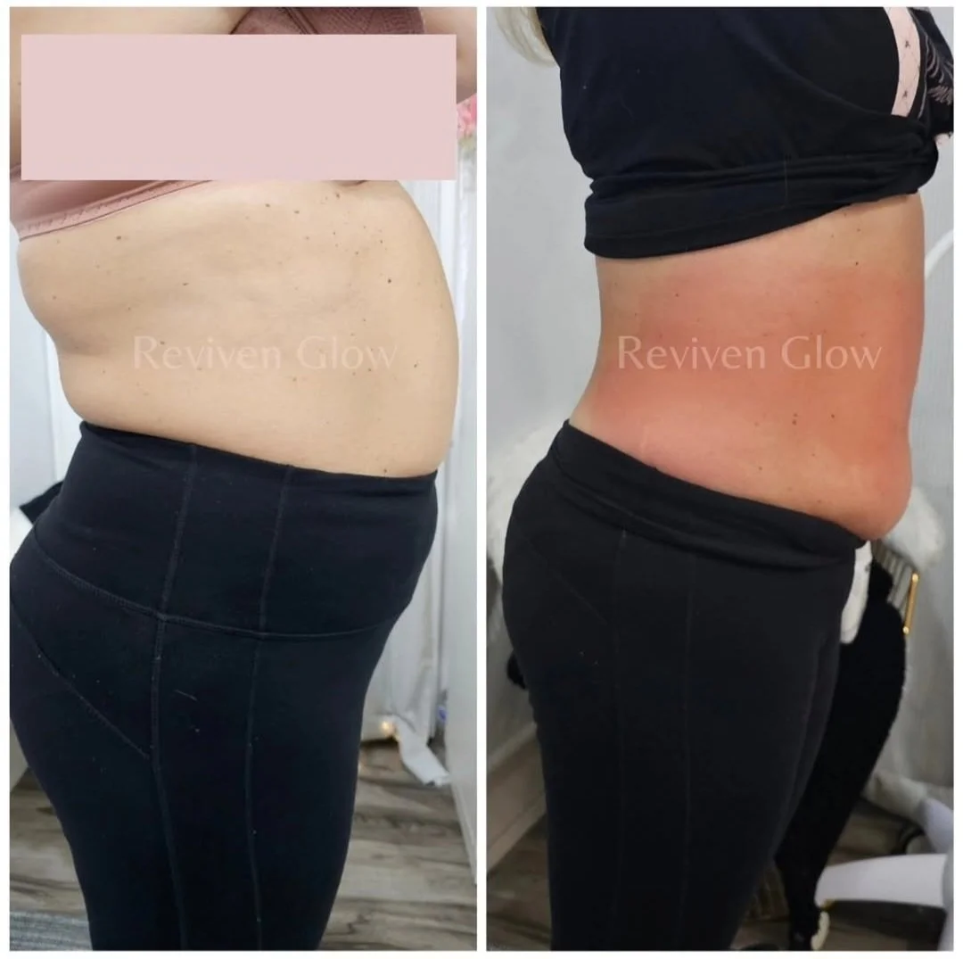 Side-by-side comparison of a woman's midsection before and after a skincare or body treatment, showing improved skin appearance and reduced redness.