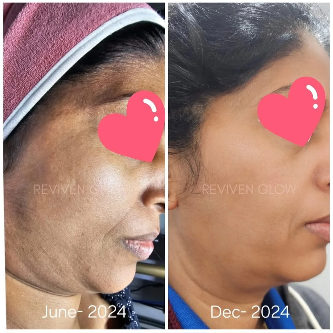 Side-by-side comparison of a woman's face showing skin improvement from June to December 2024, with a noticeable reduction in acne scars and more even skin tone.