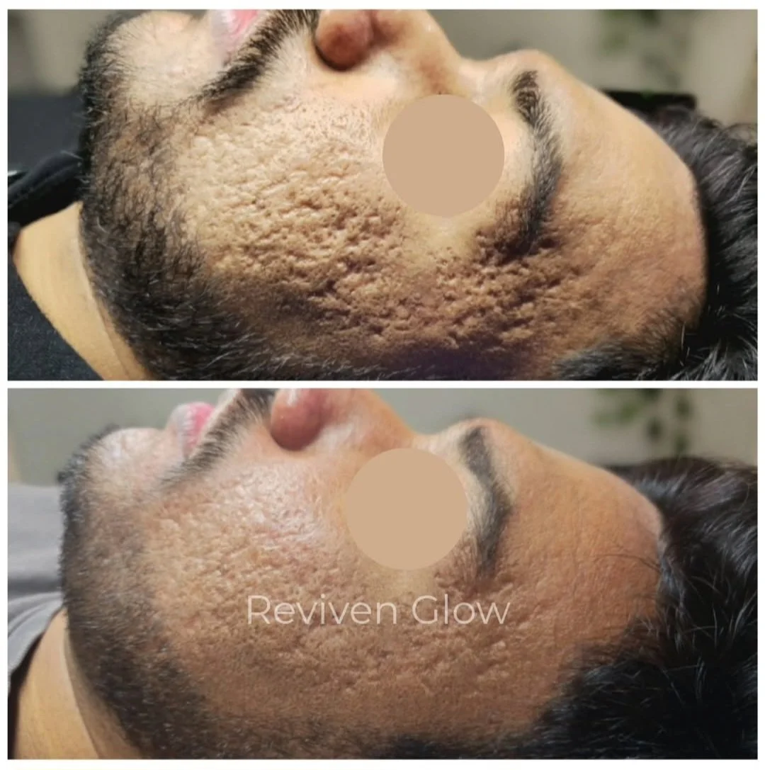 Side-by-side comparison of a man's face showing a significant reduction in acne scars and textured skin after treatment, labeled 'Reviven Glow'.