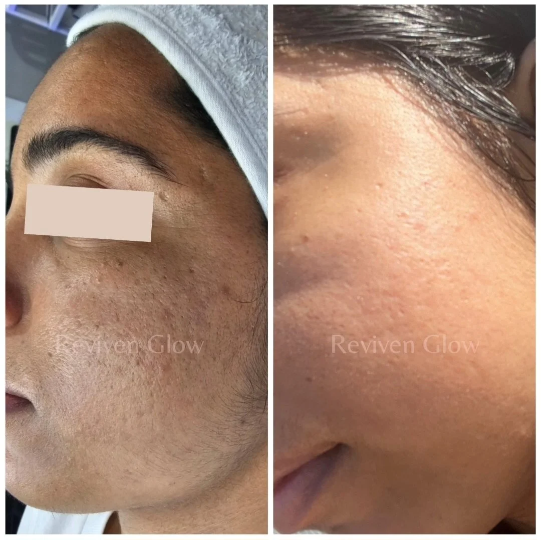 Comparison of a person's cheek before and after skincare treatment, showing smoother, clearer skin on the right side after treatment.