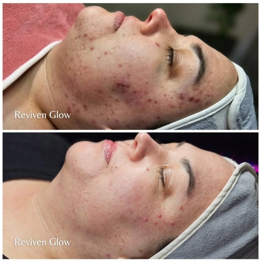 Side-by-side comparison of a woman's face showing before and after skincare treatment, with the top image displaying acne scars and blemishes, and the bottom image showing clearer, smoother skin. The images are labeled "Reviven Glow."