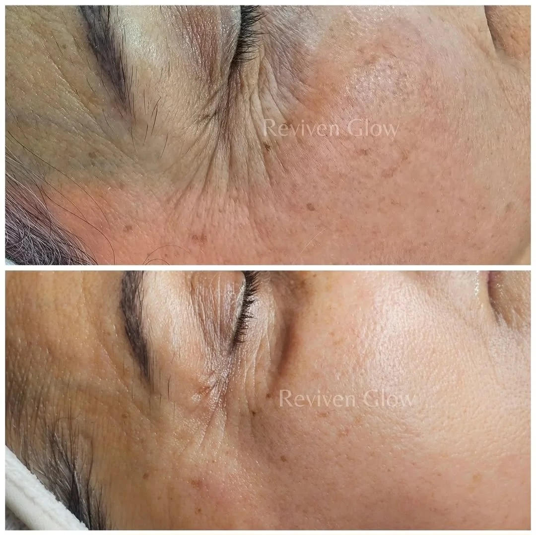 Close-up of a person's cheek and eye area showing improvement in skin texture and reduction of wrinkles and pigmentation after skincare treatment.