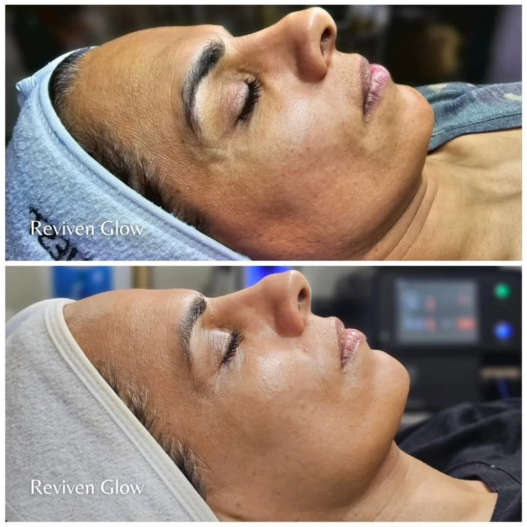 Before and after images of a woman receiving a skincare treatment, showing improved skin glow and texture.