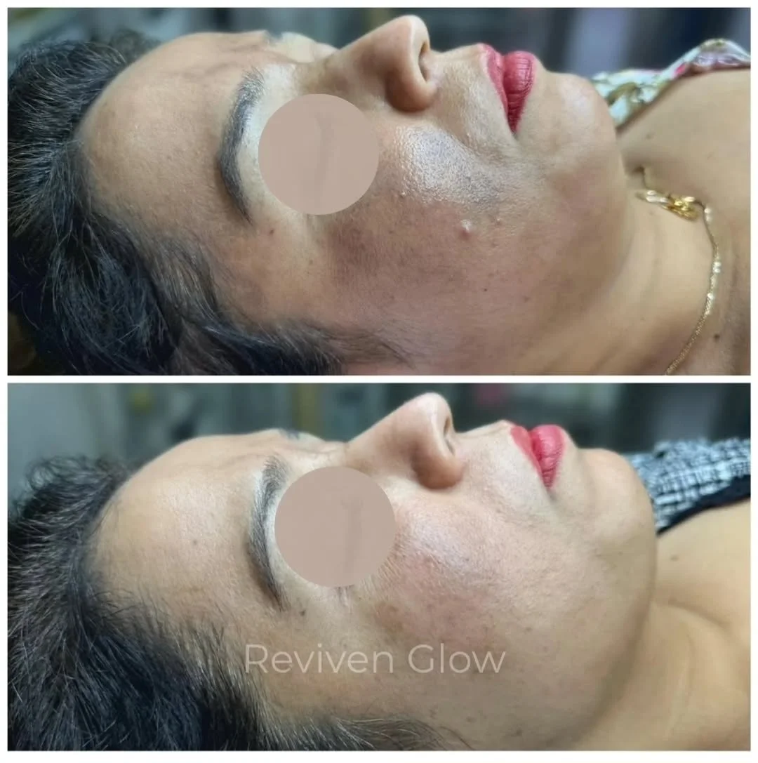 Side-by-side comparison of a woman's face before and after a skincare treatment, showing improvement in skin texture and clarity.
