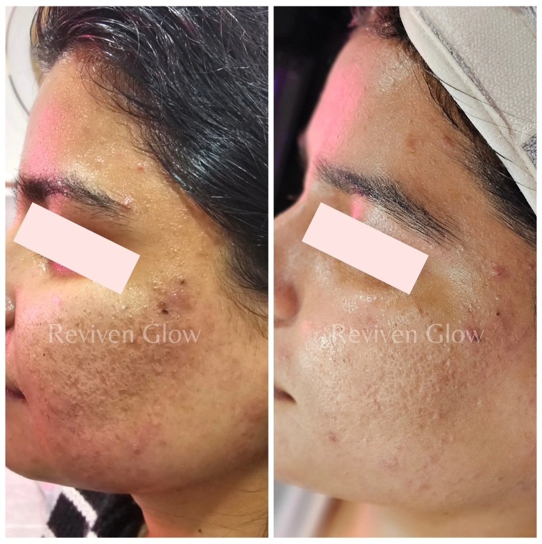 Side-by-side comparison of a woman's face showing improved skin texture and fewer blemishes after treatment, with visible redness and healing signs.