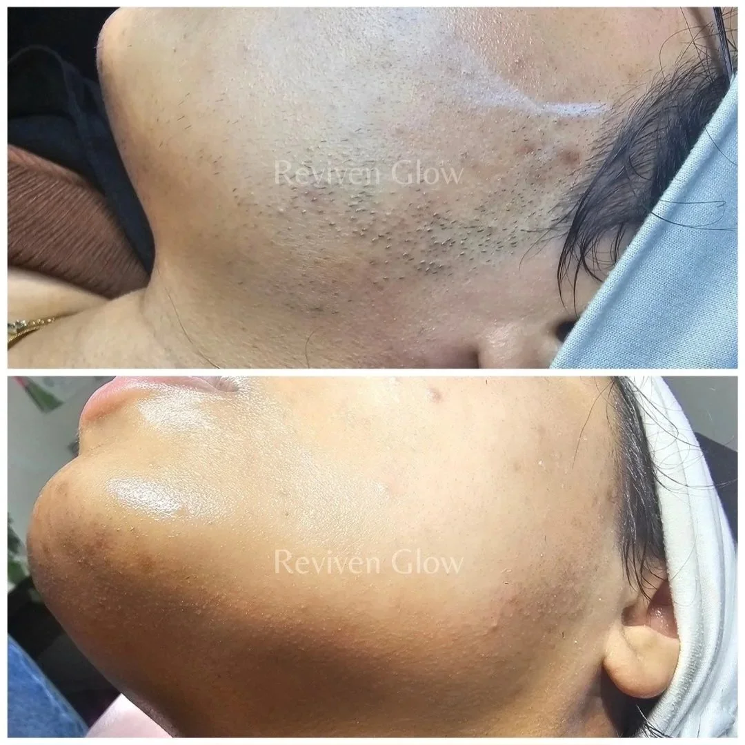 Before and after images of a person's face showing skin improvement. The top image shows rough, uneven, and bumpy skin, while the bottom image displays smooth, clear, and glowing skin.