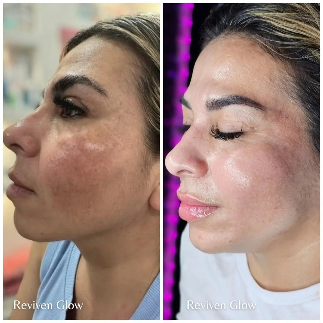 Side-by-side comparison of a woman's face before and after skincare treatment, showing clearer skin and reduced pigmentation on the right side. The left side shows uneven skin tone with hyperpigmentation, while the right side appears smooth and glowing. Labels read "Reviven Glow."
